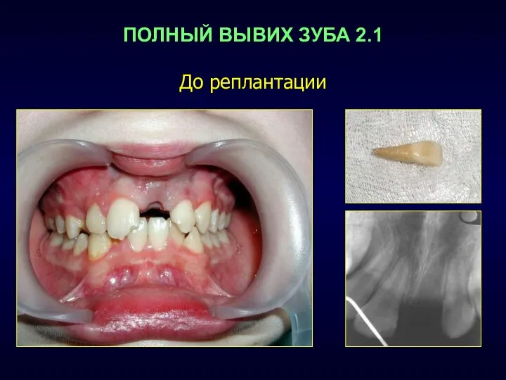 ПОЛНЫЙ ВЫВИХ ЗУБА 2.1 До реплантации