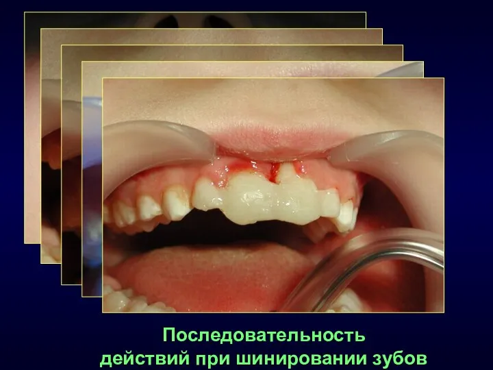 Последовательность действий при шинировании зубов