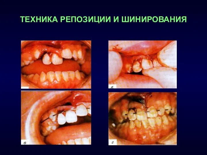 ТЕХНИКА РЕПОЗИЦИИ И ШИНИРОВАНИЯ