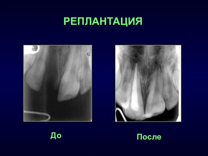 После До РЕПЛАНТАЦИЯ