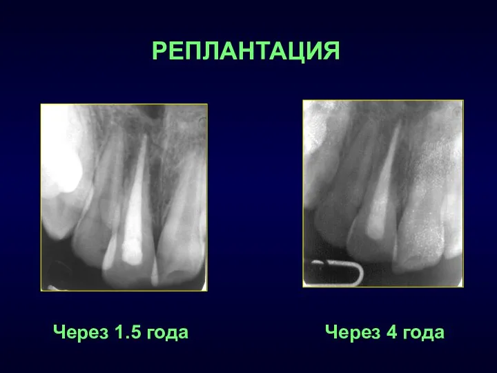 Через 4 года Через 1.5 года РЕПЛАНТАЦИЯ