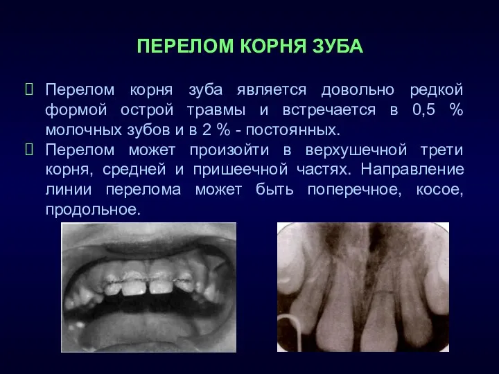 ПЕРЕЛОМ КОРНЯ ЗУБА Перелом корня зуба является довольно редкой формой острой