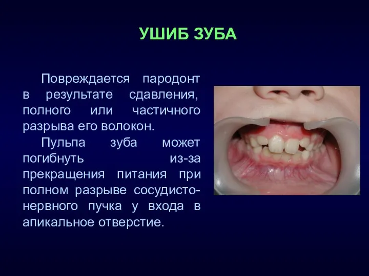 УШИБ ЗУБА Повреждается пародонт в результате сдавления, полного или частичного разрыва