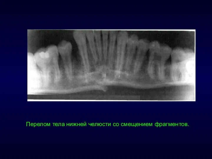 Перелом тела нижней челюсти со смещением фрагментов.