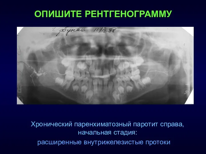 Хронический паренхиматозный паротит справа, начальная стадия: расширенные внутрижелезистые протоки ОПИШИТЕ РЕНТГЕНОГРАММУ