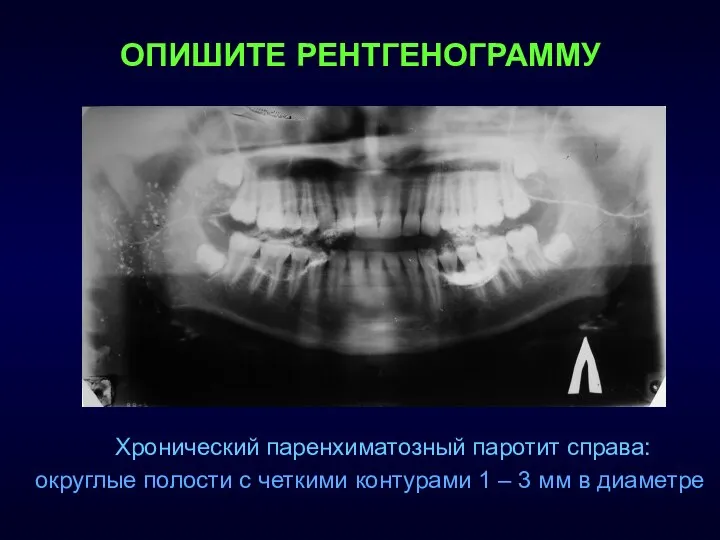 Хронический паренхиматозный паротит справа: округлые полости с четкими контурами 1 –