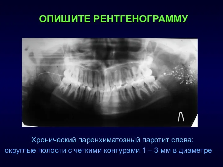 Хронический паренхиматозный паротит слева: округлые полости с четкими контурами 1 –