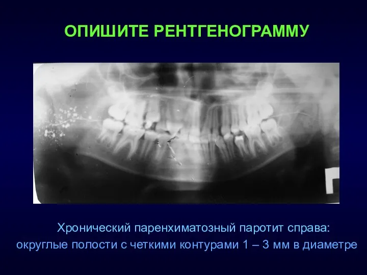 Хронический паренхиматозный паротит справа: округлые полости с четкими контурами 1 –