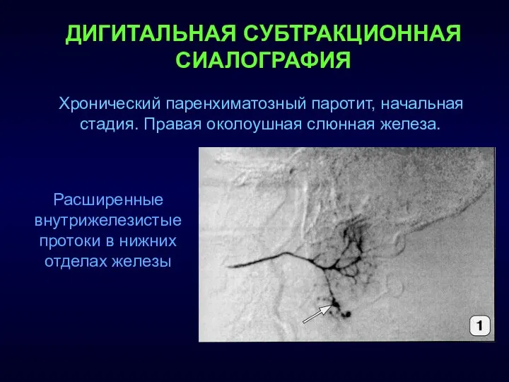 ДИГИТАЛЬНАЯ СУБТРАКЦИОННАЯ СИАЛОГРАФИЯ Хронический паренхиматозный паротит, начальная стадия. Правая околоушная слюнная