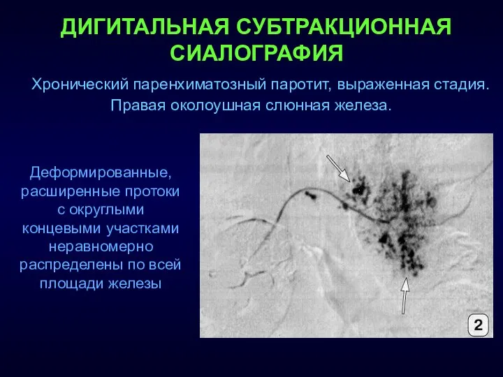 ДИГИТАЛЬНАЯ СУБТРАКЦИОННАЯ СИАЛОГРАФИЯ Хронический паренхиматозный паротит, выраженная стадия. Правая околоушная слюнная