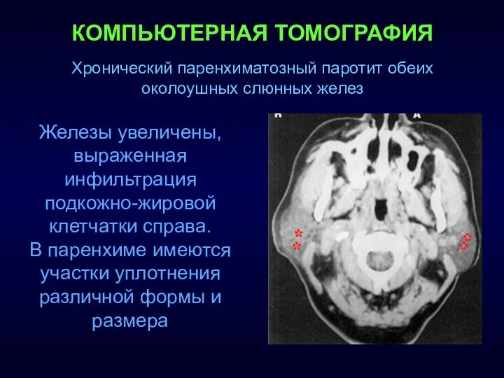 КОМПЬЮТЕРНАЯ ТОМОГРАФИЯ Железы увеличены, выраженная инфильтрация подкожно-жировой клетчатки справа. В паренхиме