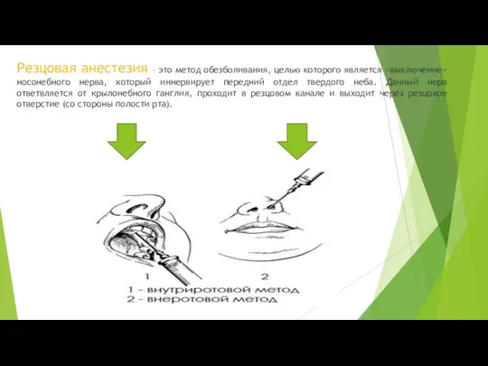 Резцовая анестезия – это метод обезболивания, целью которого является «выключение» носонебного