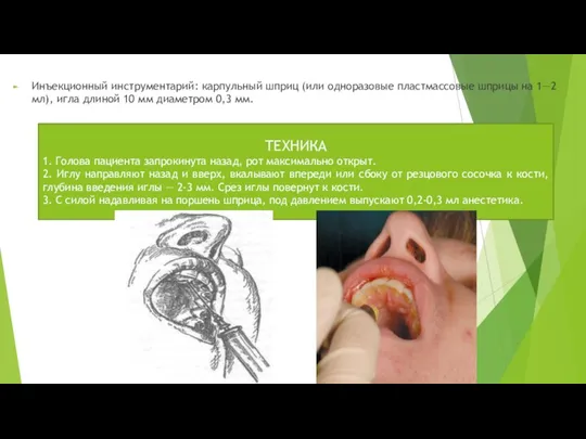 Инъекционный инструментарий: карпульный шприц (или одноразовые пластмассовые шприцы на 1—2 мл),