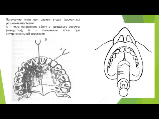 Положение иглы при разных видах (вариантах) резцовой анестезии: А — игла