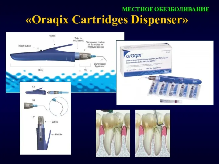 «Oraqix Cartridges Dispenser» МЕСТНОЕ ОБЕЗБОЛИВАНИЕ