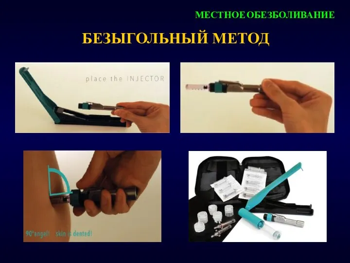 БЕЗЫГОЛЬНЫЙ МЕТОД МЕСТНОЕ ОБЕЗБОЛИВАНИЕ