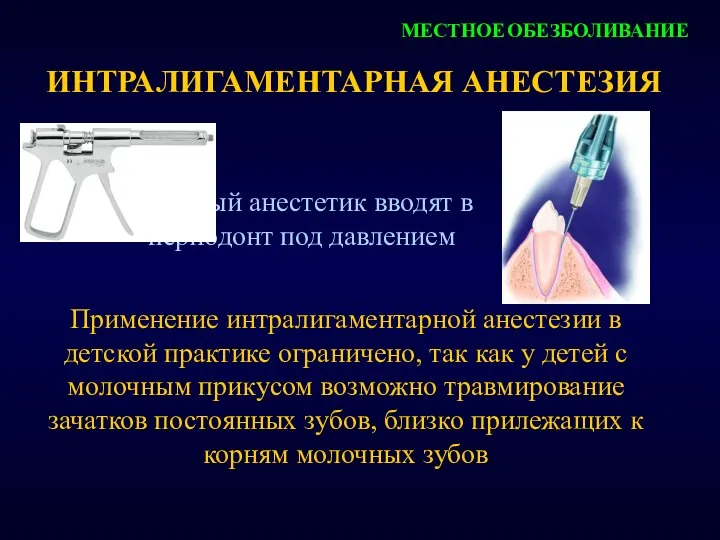 ИНТРАЛИГАМЕНТАРНАЯ АНЕСТЕЗИЯ местный анестетик вводят в периодонт под давлением МЕСТНОЕ ОБЕЗБОЛИВАНИЕ