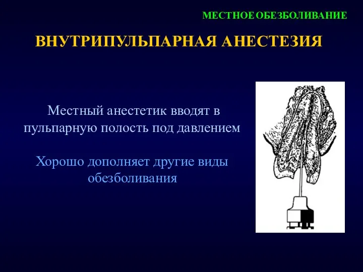 ВНУТРИПУЛЬПАРНАЯ АНЕСТЕЗИЯ Местный анестетик вводят в пульпарную полость под давлением Хорошо