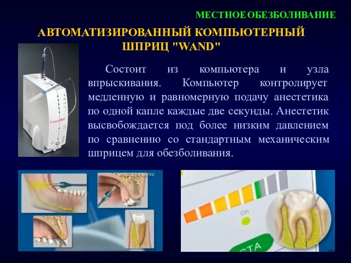 АВТОМАТИЗИРОВАННЫЙ КОМПЬЮТЕРНЫЙ ШПРИЦ "WAND" МЕСТНОЕ ОБЕЗБОЛИВАНИЕ Состоит из компьютера и узла