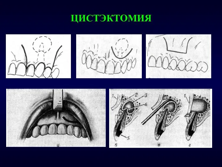 ЦИСТЭКТОМИЯ