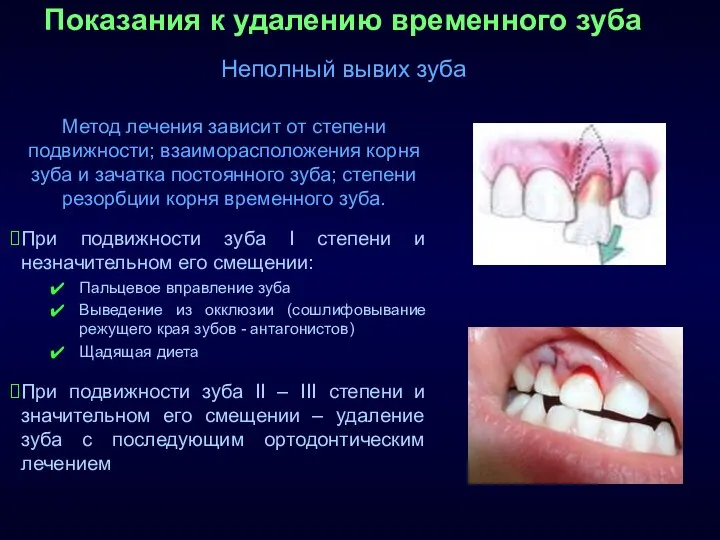 Показания к удалению временного зуба Неполный вывих зуба Метод лечения зависит