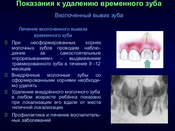 Показания к удалению временного зуба Вколоченный вывих зуба Лечение вколоченного вывиха