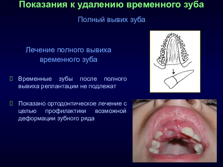 Показания к удалению временного зуба Полный вывих зуба Лечение полного вывиха