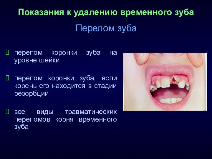 Показания к удалению временного зуба Перелом зуба перелом коронки зуба на