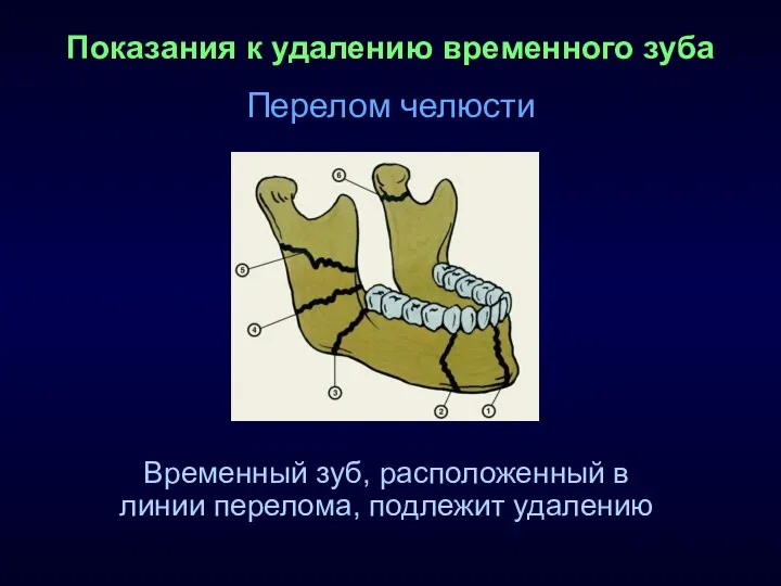 Показания к удалению временного зуба Перелом челюсти Временный зуб, расположенный в линии перелома, подлежит удалению