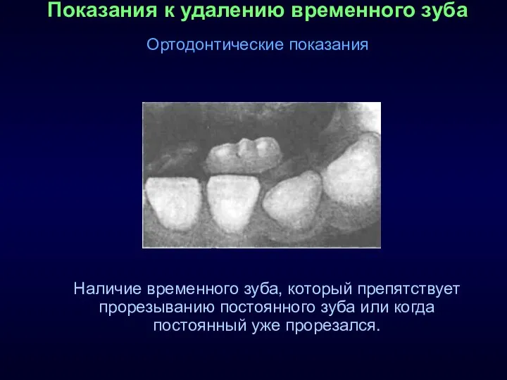 Показания к удалению временного зуба Ортодонтические показания Наличие временного зуба, который