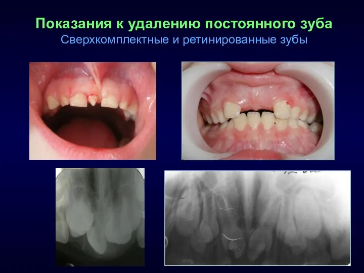 Показания к удалению постоянного зуба Сверхкомплектные и ретинированные зубы