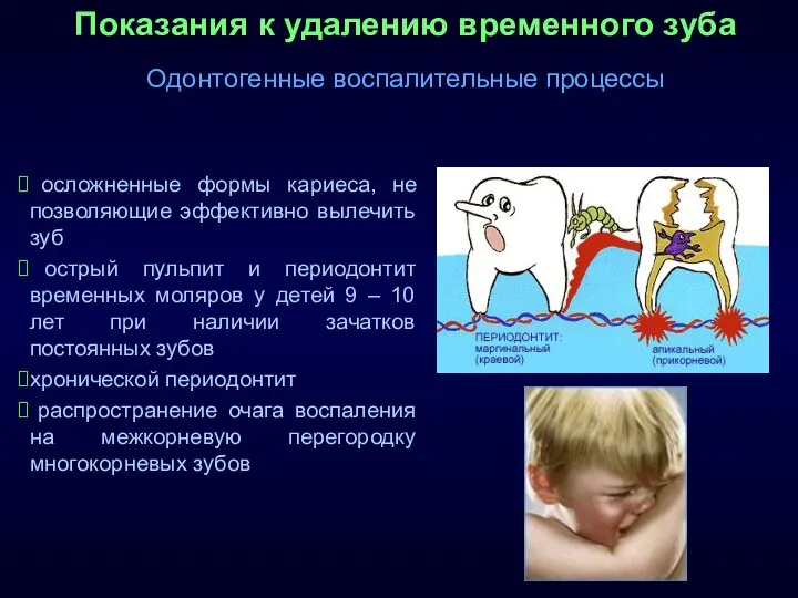 Показания к удалению временного зуба Одонтогенные воспалительные процессы осложненные формы кариеса,