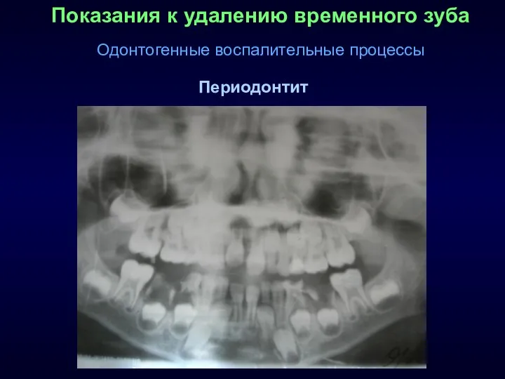 Показания к удалению временного зуба Одонтогенные воспалительные процессы Периодонтит