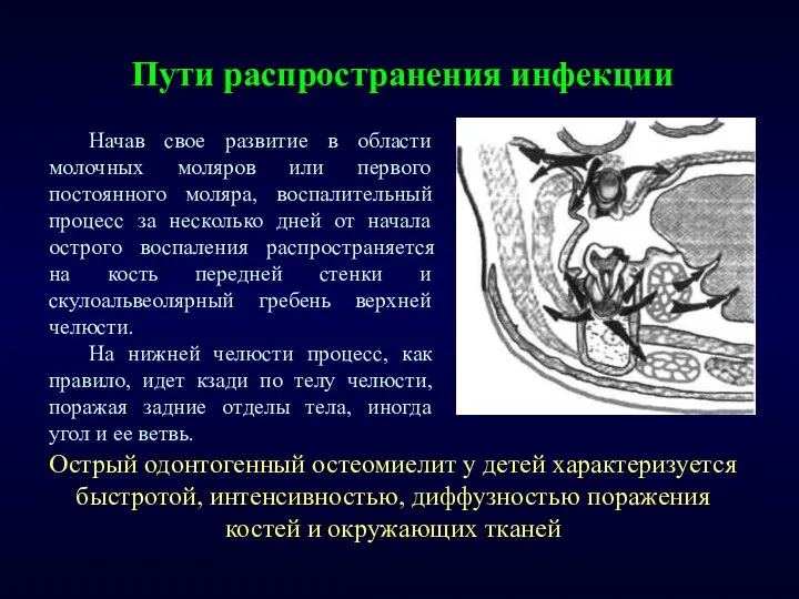 Пути распространения инфекции Начав свое развитие в области молочных моляров или