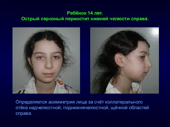 Ребёнок 14 лет. Острый серозный периостит нижней челюсти справа. Определяется асимметрия