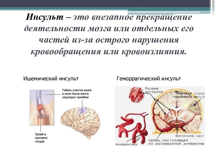 Инсульт – это внезапное прекращение деятельности мозга или отдельных его частей