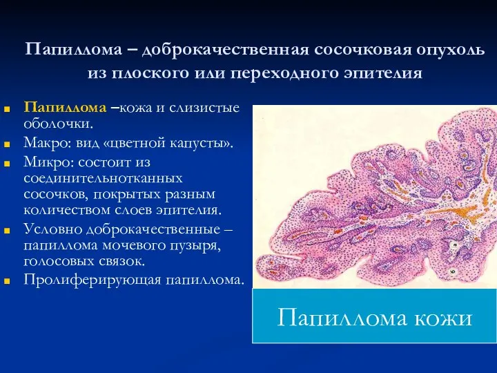 Папиллома – доброкачественная сосочковая опухоль из плоского или переходного эпителия Папиллома