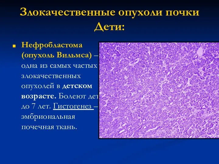 Злокачественные опухоли почки Дети: Нефробластома (опухоль Вильмса) – одна из самых