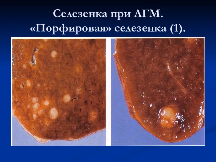 Селезенка при ЛГМ. «Порфировая» селезенка (1).