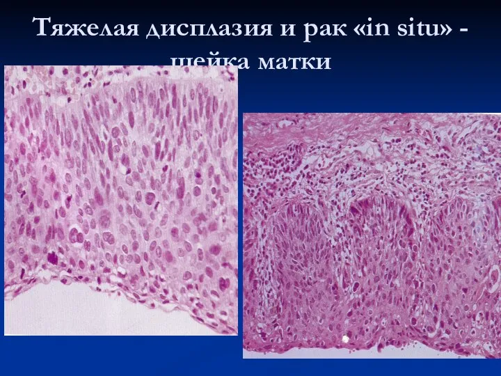 Тяжелая дисплазия и рак «in situ» - шейка матки