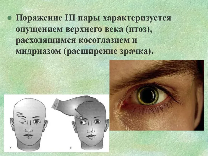 Поражение III пары характеризуется опущением верхнего века (птоз), расходящимся косоглазием и мидриазом (расширение зрачка).