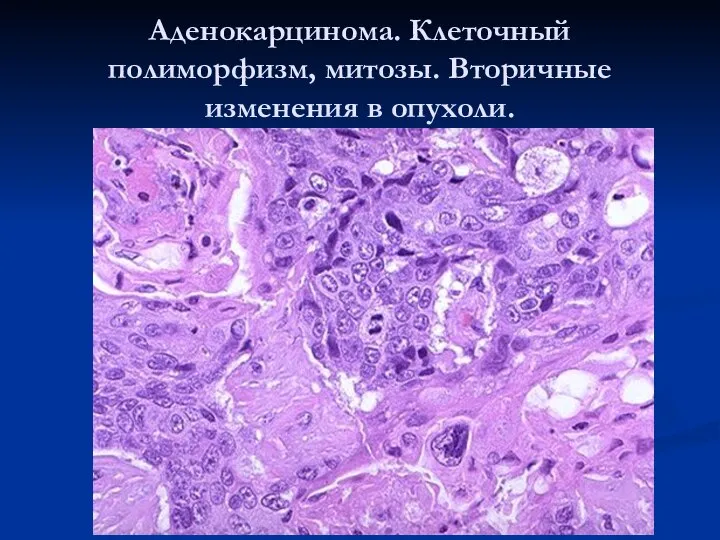 Аденокарцинома. Клеточный полиморфизм, митозы. Вторичные изменения в опухоли.