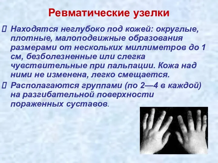 Ревматические узелки Находятся неглубоко под кожей: округлые, плотные, малоподвижные образования размерами