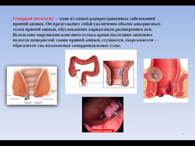 Геморрой (почечуй) — одно из самых распространенных заболеваний прямой кишки. Он