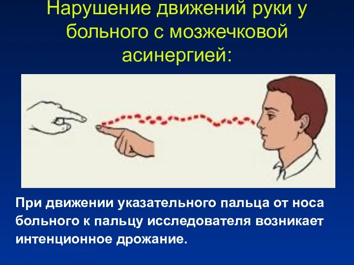 Нарушение движений руки у больного с мозжечковой асинергией: При движении указательного