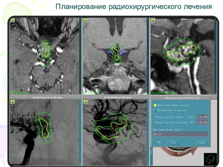 Планирование радиохирургического лечения