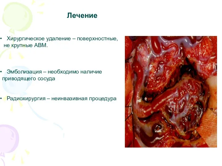 Лечение Хирургическое удаление – поверхностные, не крупные АВМ. Эмболизация – необходимо