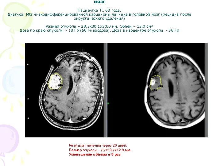 Пример радиохирургического лечения одиночного метастаза в головной мозг Пациентка Т., 63