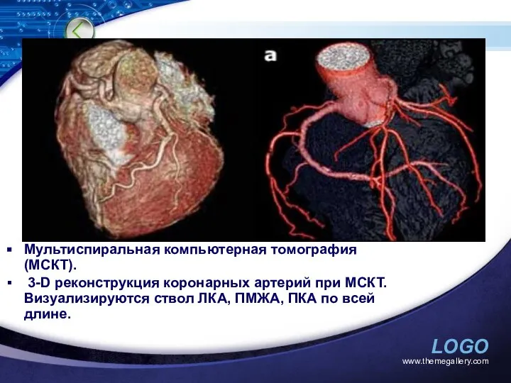 www.themegallery.com Мультиспиральная компьютерная томография (МСКТ). 3-D реконструкция коронарных артерий при МСКТ.