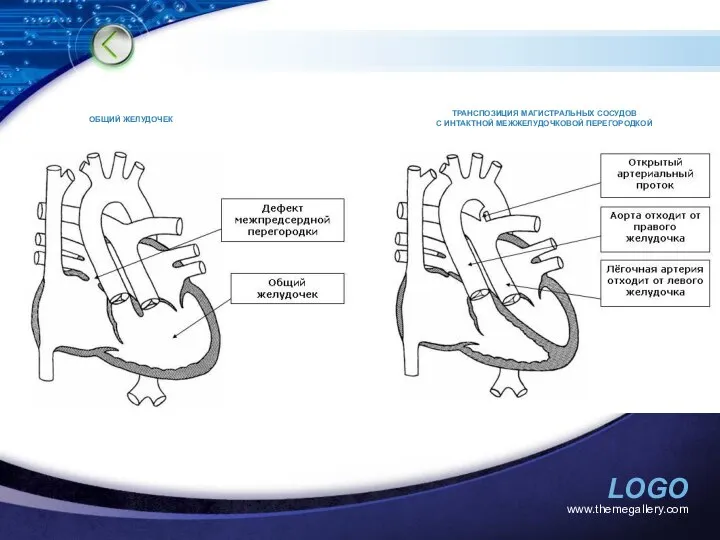 www.themegallery.com ОБЩИЙ ЖЕЛУДОЧЕК ТРАНСПОЗИЦИЯ МАГИСТРАЛЬНЫХ СОСУДОВ С ИНТАКТНОЙ МЕЖЖЕЛУДОЧКОВОЙ ПЕРЕГОРОДКОЙ